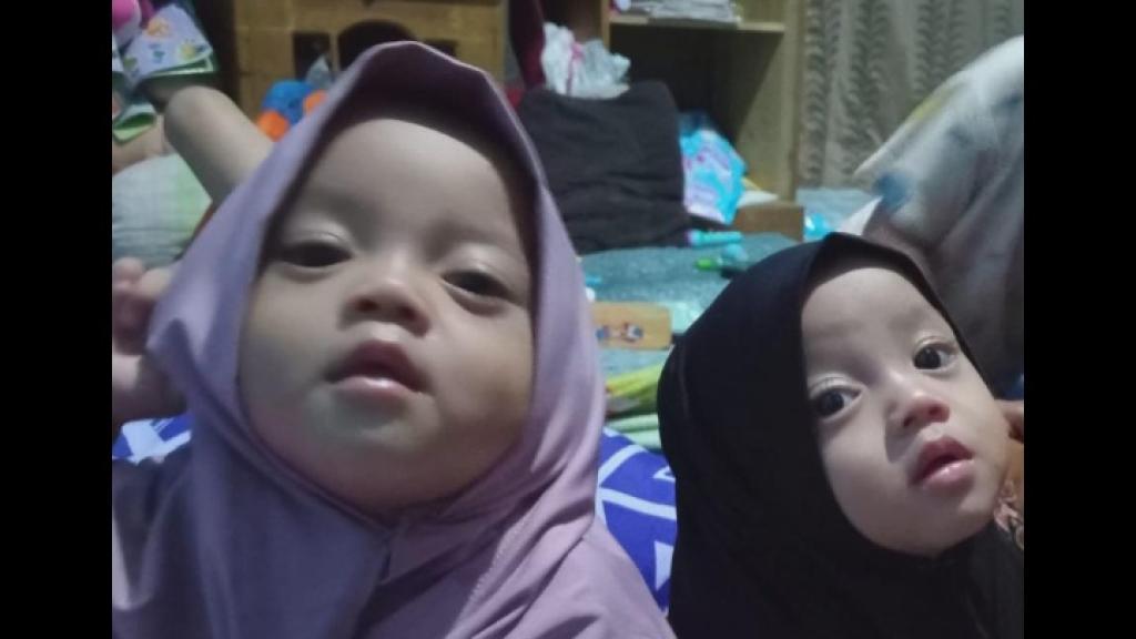 Harapan Baru untuk Nadia & Nadira, Kembar Siam yang Butuh Biaya Operasi Pemisahan Rp500 Juta