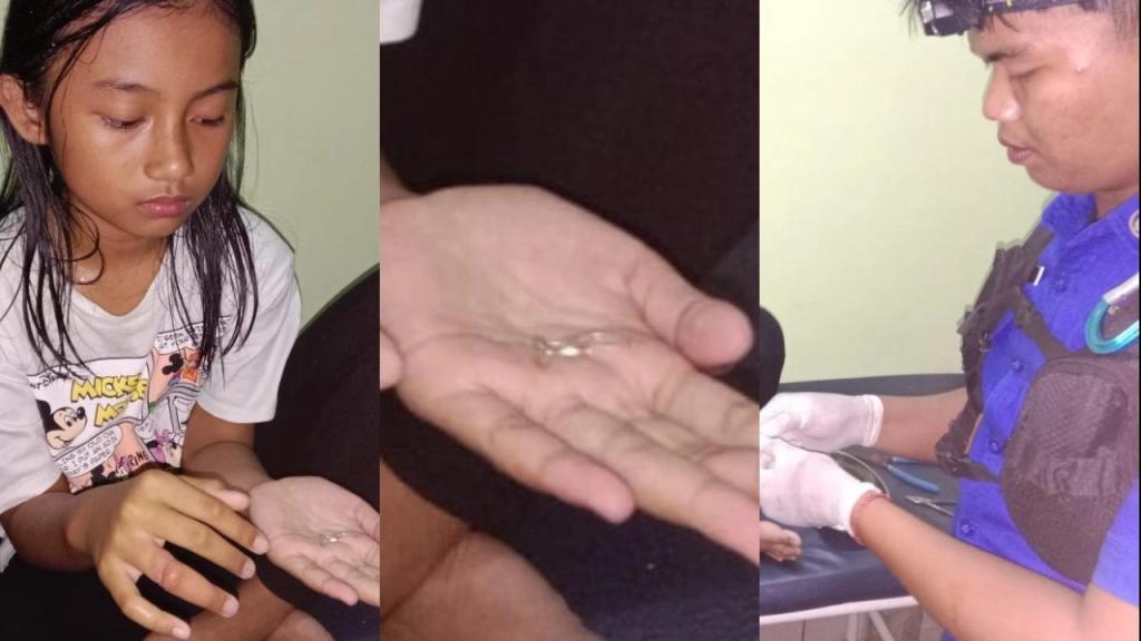 Petugas Damkar Kota Tasikmalaya Berhasil Lepaskan Cincin di Jari Tangan Anak