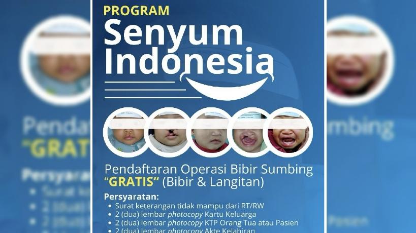 RS TMC Tasikmalaya Buka Pendaftaran Operasi Bibir Sumbing Gratis, Pelaksanaan September 2025